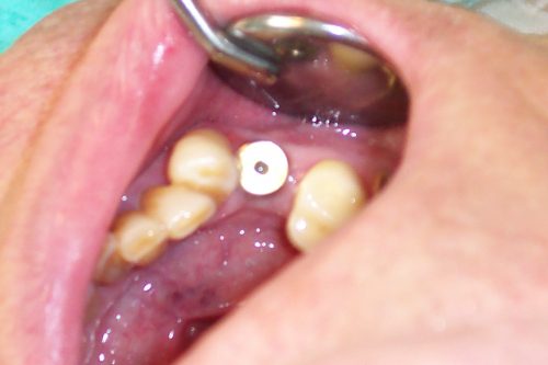implant replacement2
