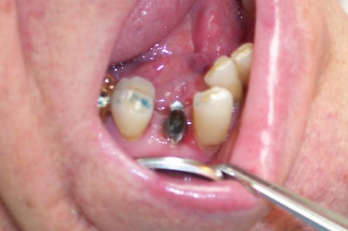 implant replacement4